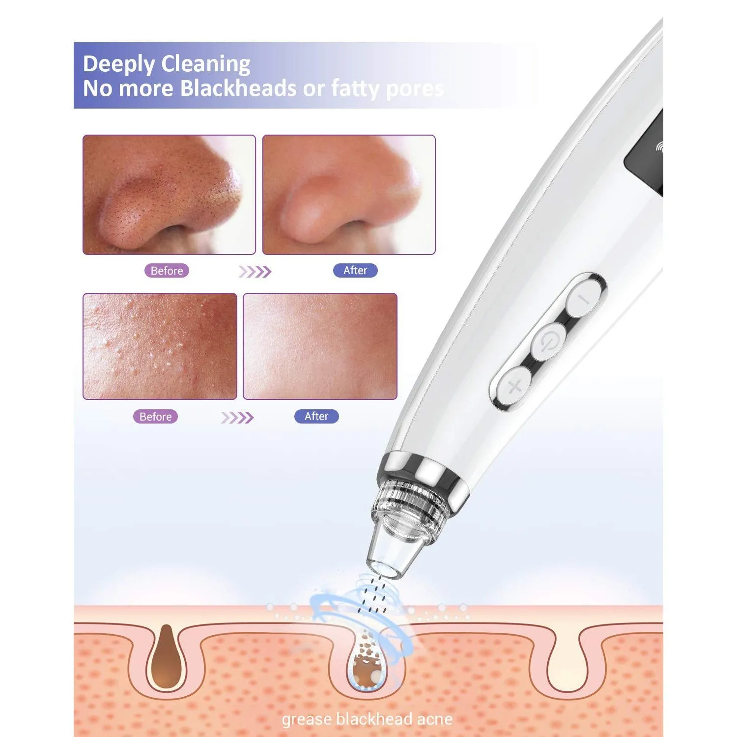 Blackhead Pore Vacuum Cleaner Remover